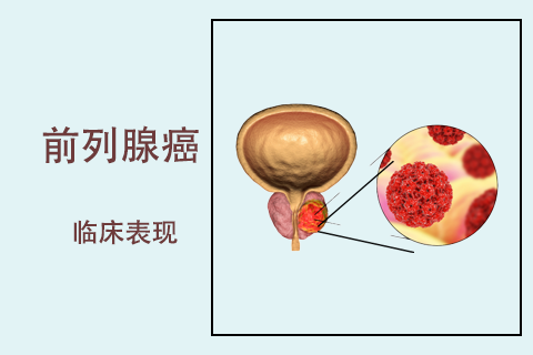 什么是前列腺癌